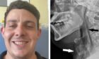 Andrew McDougall tore a hole in his windpipe while stifling a sneeze. Image: Andrew McDougall/British Medical Journal