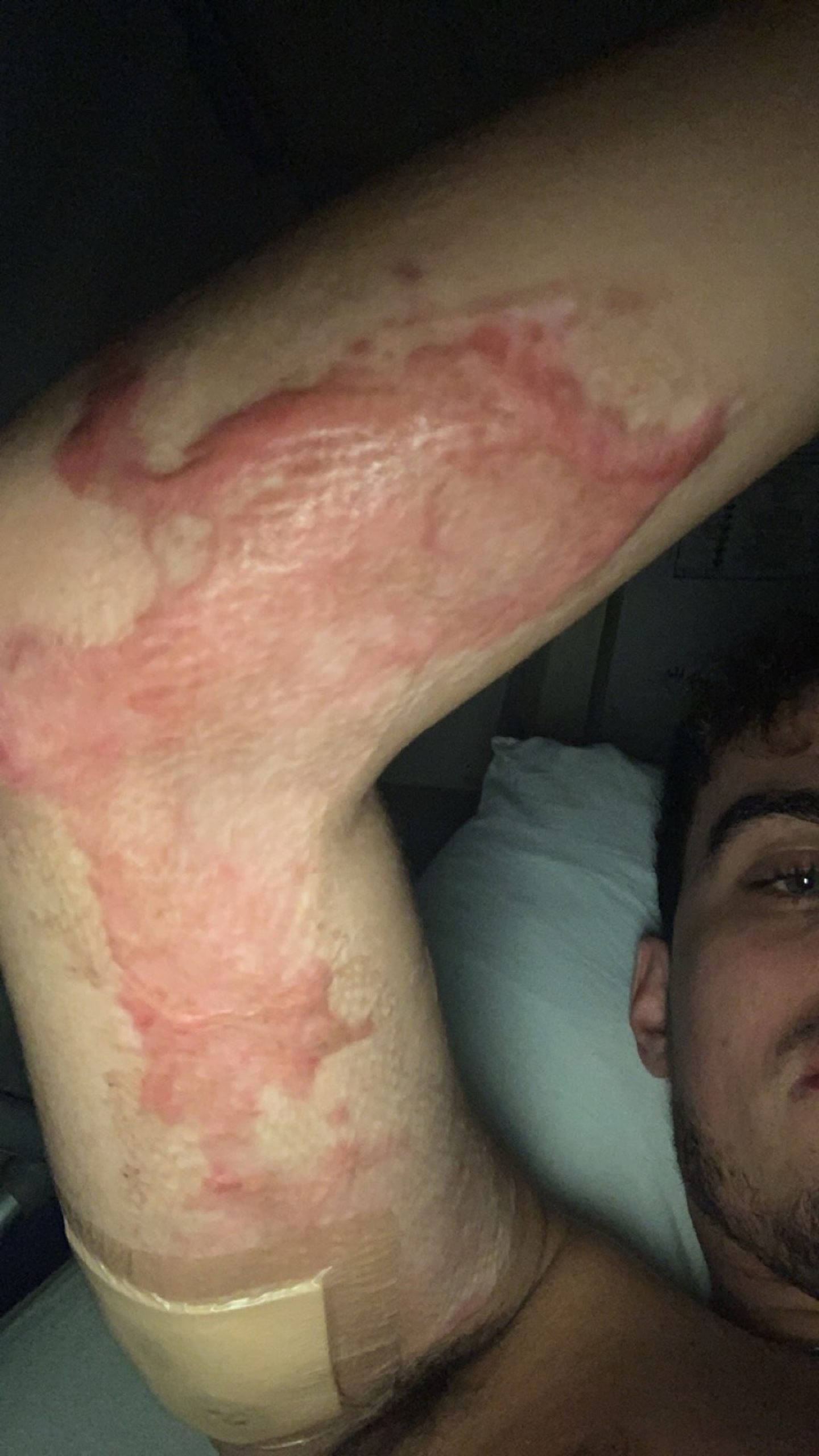Chemical burn marks on Jordan's arm