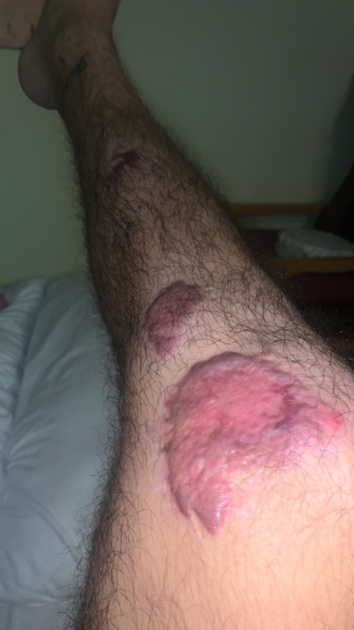 Burn injuries on Jordan's leg.