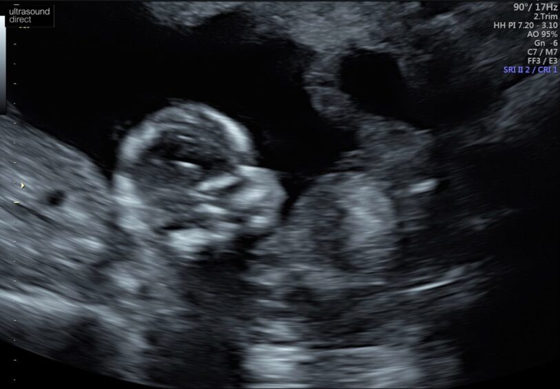 Image from 12-week scan