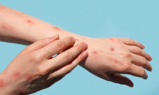 A measles case has been confirmed in Fife. Image: Shutterstock