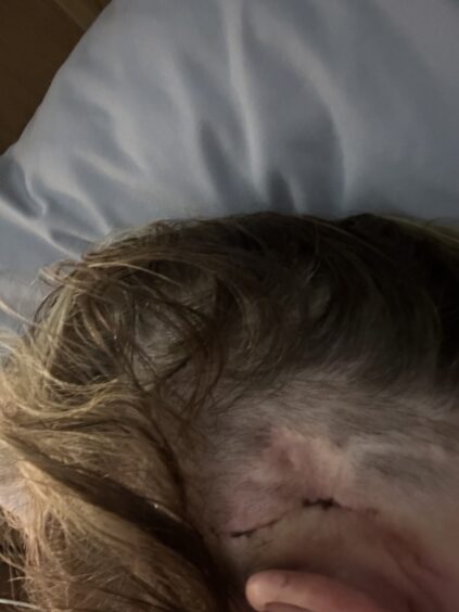 Dundee Eljamel patient, Dawn Harris' scar on her scalp behind her ear