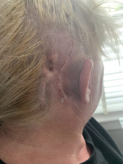 Dundee Eljamel patient, Dawn Harris showing her visible scarring on her scalp behind her ear