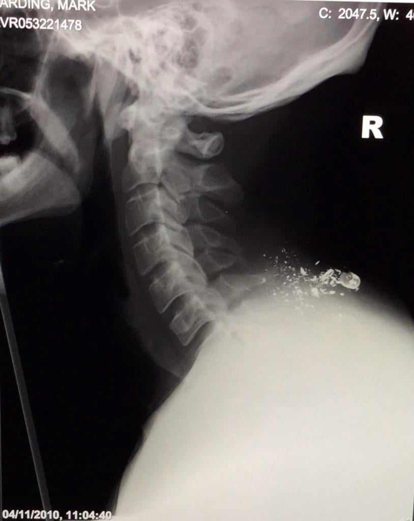 The x-ray showing the bullet lodged in Mark's neck.