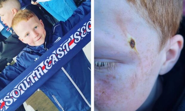 Dundee fan Levi, 10, was hit by a flare in the away end at St Johntsone's McDiarmid Park.