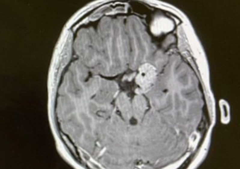 An image from Joscelyne Kerr brain scan showing the tumour in the middle