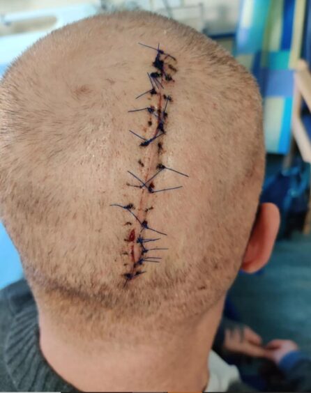 Steven McCready brain surgery scar