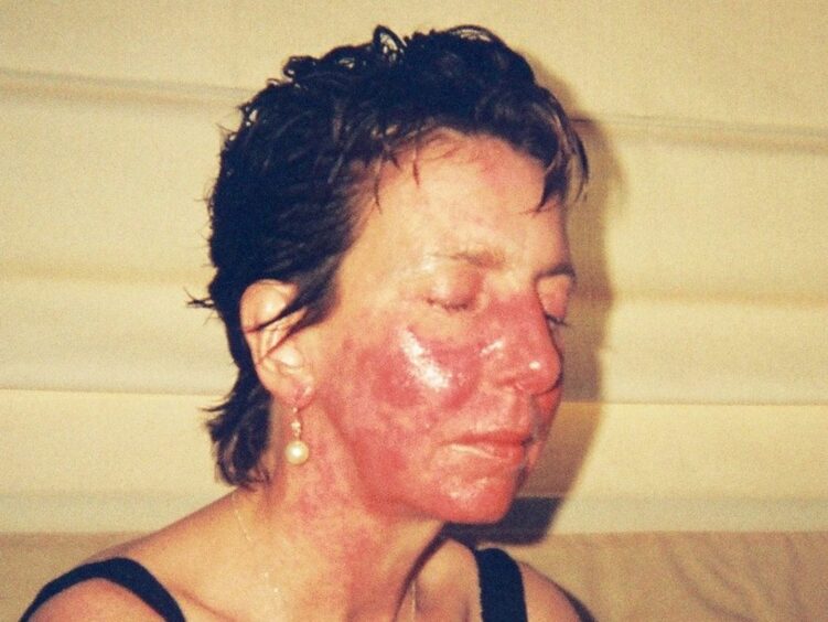 Perthshire mum Gill's skin swells up and blisters if she is exposed to light.