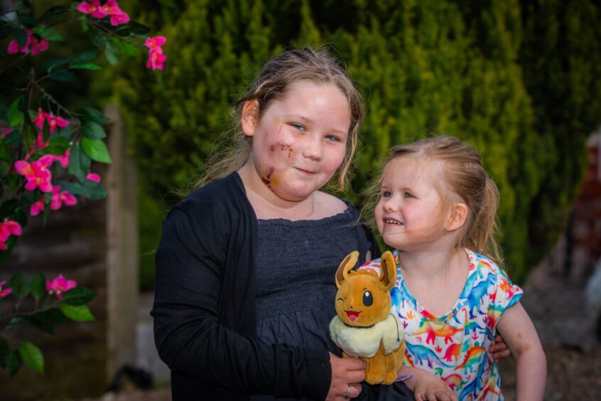 Alyssa MacDonald with scarred face, seated next to her three year-old sister Julie in a garden