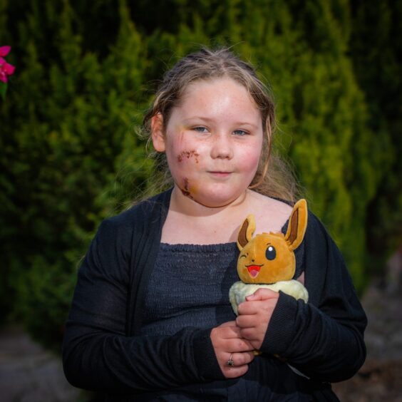 Alyssa MacDonald with stitches on face holding a Pokemon toy