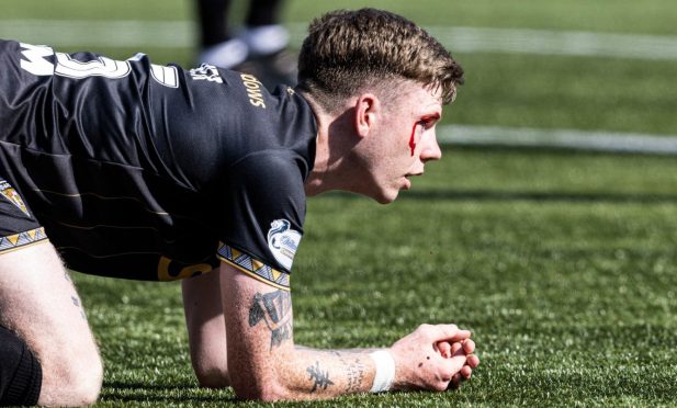 Dunfermline Athletic F.C. defender Sam Fisher with a cut eye.