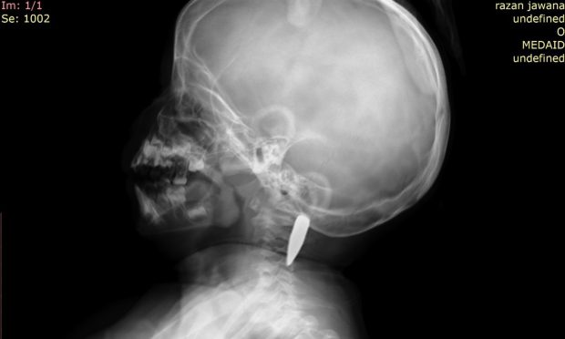 X-ray of the bullet lodged in three-year-old Palestinian girl Razan's neck.