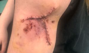 The injury suffered by the Dundee girl during the attack by a dog in Douglas. Image: Supplied
