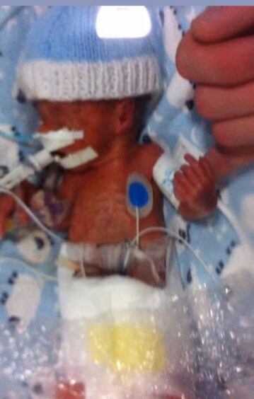 Baby Joel Larmour was born prematurely.