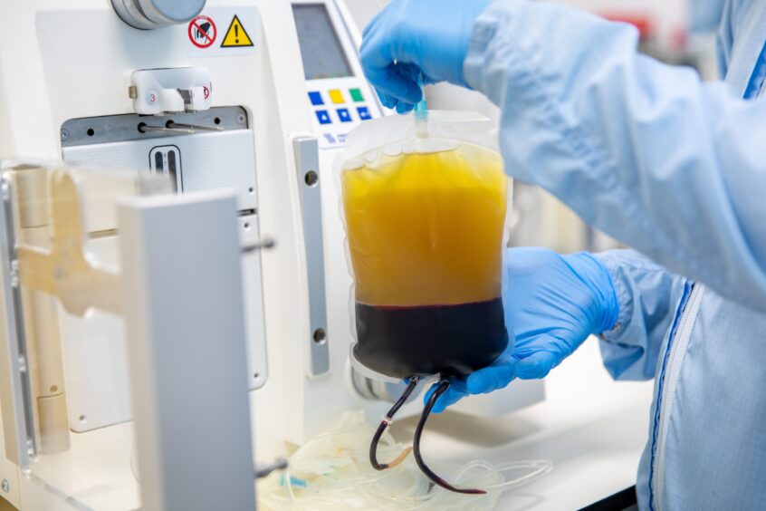 A blood bag once the centrifuge process is complete, showing plasma at the top and red cells at the bottom.