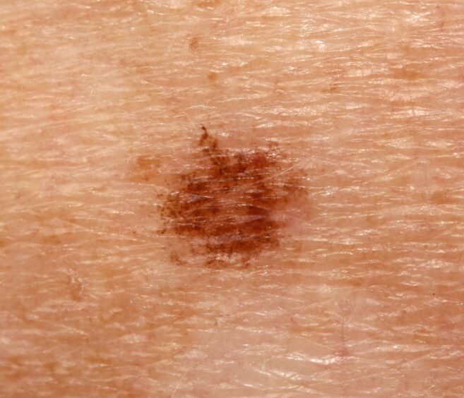 An example of an ink-spot lentigo. 