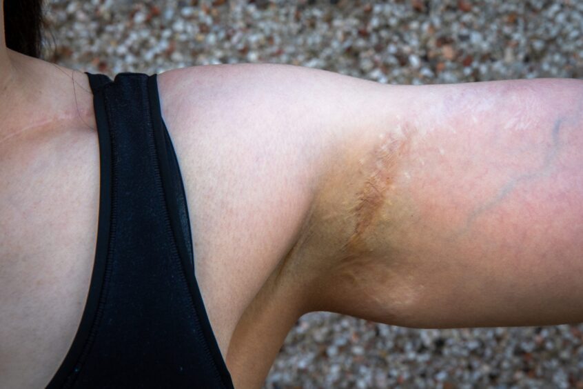 Invergowrie's Helen shows the scars from the serious arm injury she sustained as a teenager