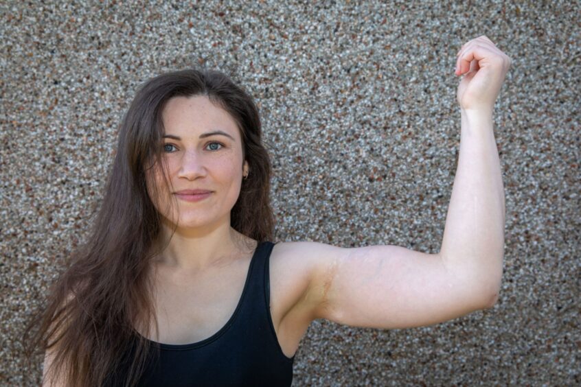 Helen doesn't have full function in her hand after the arm injury she had as a teenager.