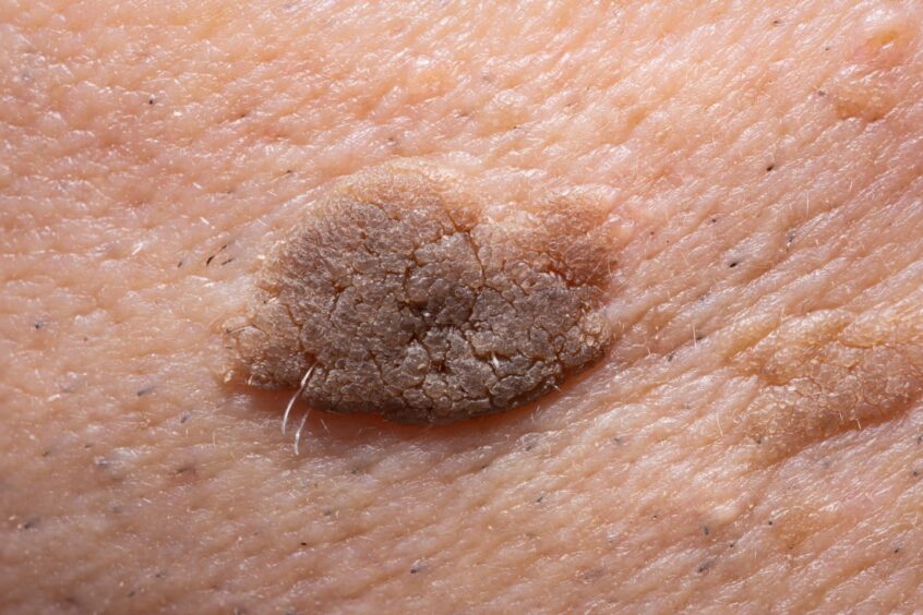 An example of a seborrheic keratosis.