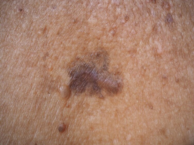An example of skin cancer or melanoma.