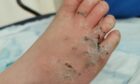 Damaged caused to Nadia's foot by a fire on Kirkcaldy's Ravenscraig Beach