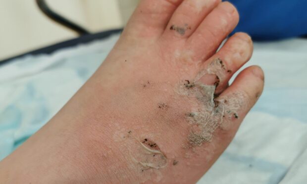 Damaged caused to Nadia's foot by a fire on Kirkcaldy's Ravenscraig Beach
