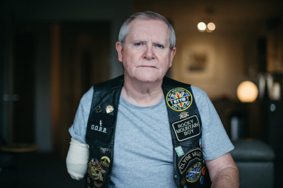 Eight years on from the accident, Malcolm opted to have his arm amputated as it gave him so much pain
