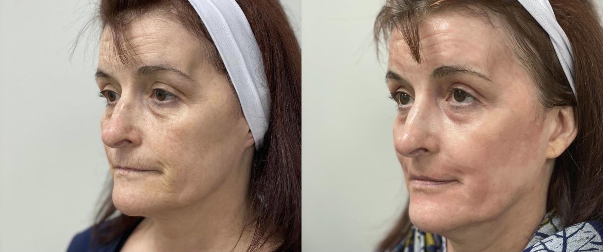 Before and after fully ablative skin resurfacing 