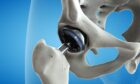 3D image of a metal hip joint