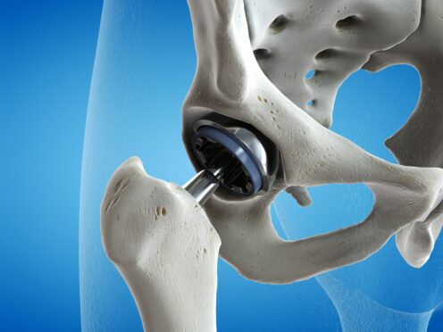 3D image of a metal hip joint