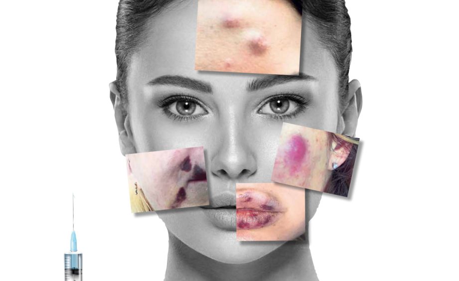 Real-life examples of fake botox leaving painful lumps and incorrectly applied filler causing severe bruising.