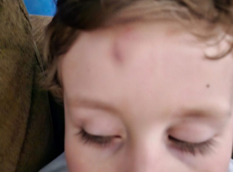 Bruises on Isaac’s head.