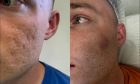 The deep acne scars on Jeffrey Southards’ face have been healed.