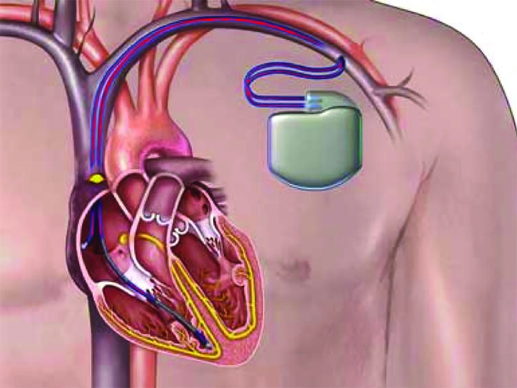 Illustration of an implantable cardioverter-defibrillator.