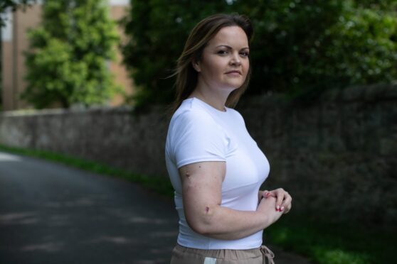 Claire Gibson has endured years of treatment for melanoma and wants to see sunbeds banned.