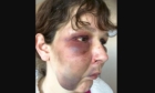 Charlene Whyte suffered horrific injuries in the attack by Thomas Chesterton and Charley Ironside
