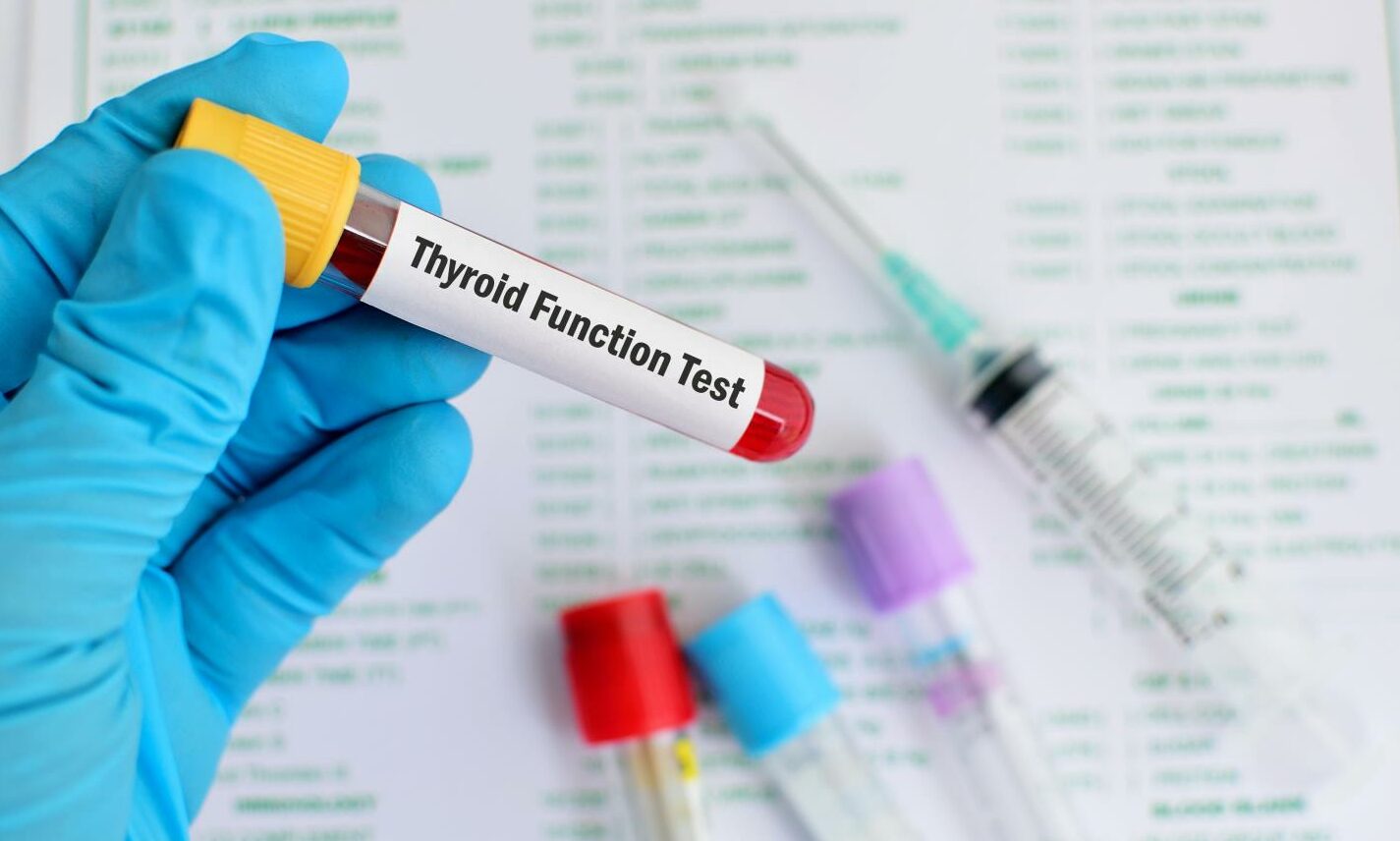 Blood sample for thyroid function test