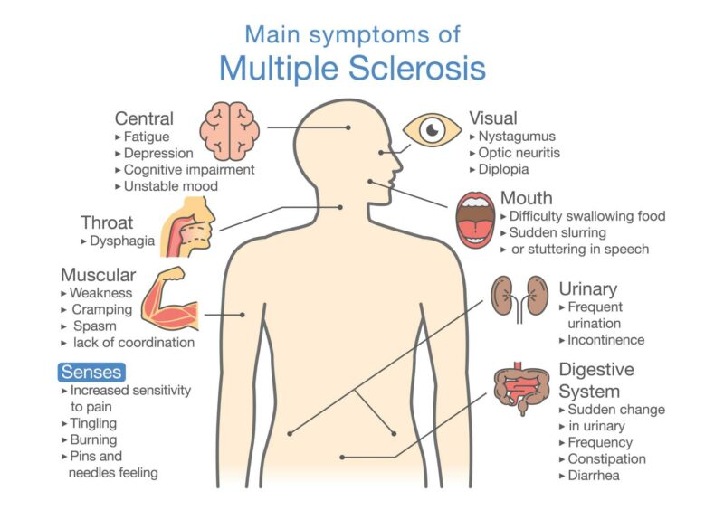  A cartoon showing the main symptoms of multiple scelrosis