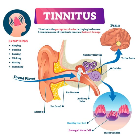 This is how tinnitus can affect the ears.