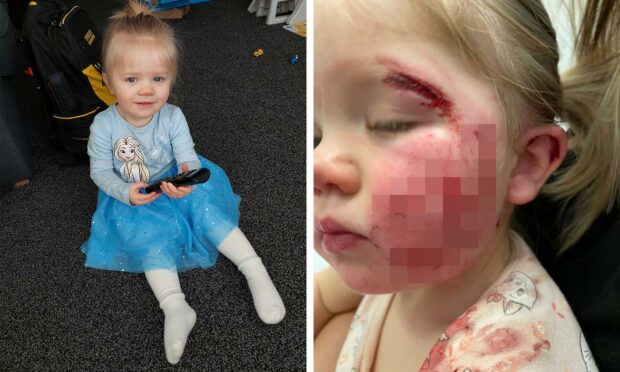 Isla was attacked by a dog at a family party last month, which resulted in her needing surgery on her face.