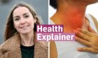 Laura Leslie next to person with lump on their neck due to overactive thyroid with the 'health explainer' logo at the bottom of the image