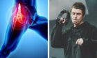 Liam Gallagher next to an x-ray of a sore hip