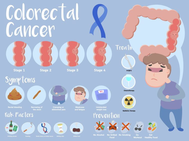 Typical bowel cancer, also known as colorectal cancer, symptoms.