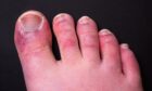 A man's toes showing what looks like a rash with red blotchy skin. A common side effect of Covid-19 often referred to as 'Covid toe'