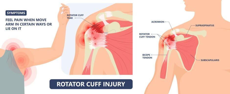 Ian had a tear in his rotator cuff, a group of muscles responsible for stabilising the shoulder joint.