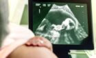 Aberdeen University study finds poverty impacts pregnancy