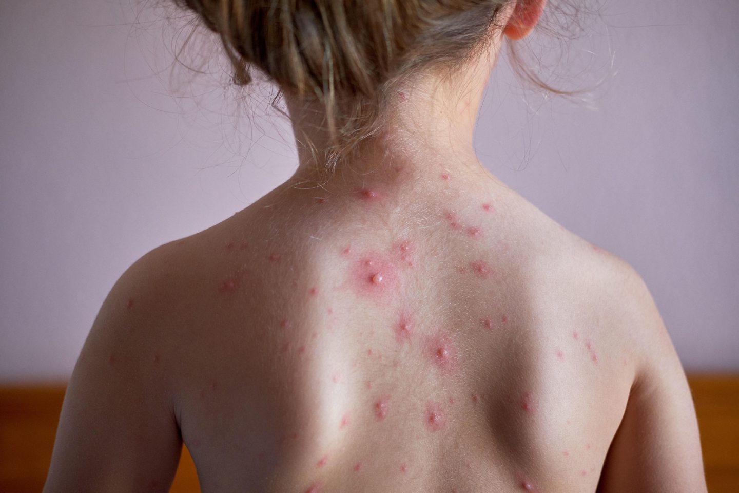 How to tell the difference between monkeypox and chickenpox in your child