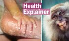 Severe monkey pox rash next to the 'Health Explainer' logo and a crab-eating macaque monkey