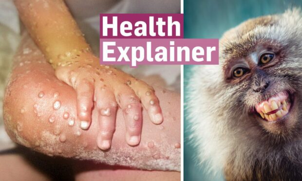 Severe monkey pox rash next to the 'Health Explainer' logo and a crab-eating macaque monkey