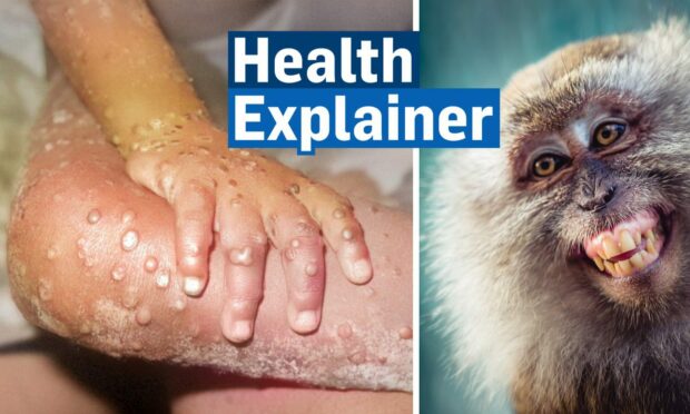 Monkeypox: Everything you need to know